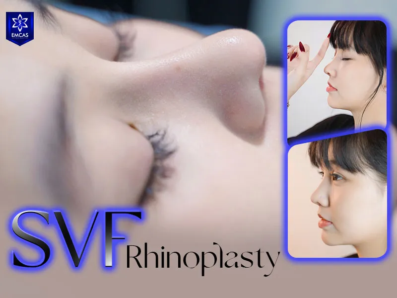 S-Line rhinoplasty consultation and treatment planning at EMCAS Aesthetic Hospital