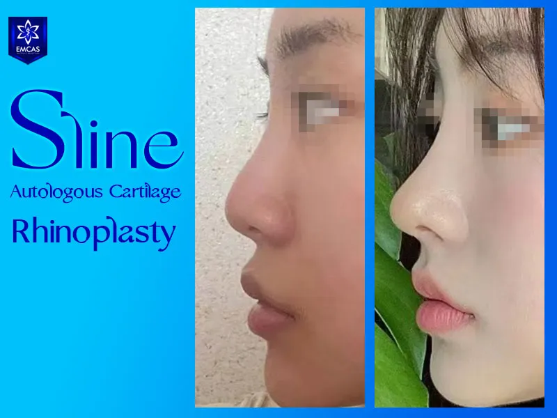 S-Line rhinoplasty with autologous cartilage may use rib, ear, or septal cartilage