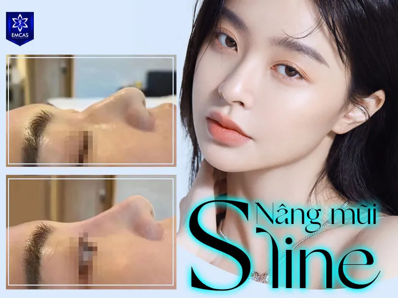 An S-Line nose has a gentle S-shaped contour from the forehead toward the nasal tip
