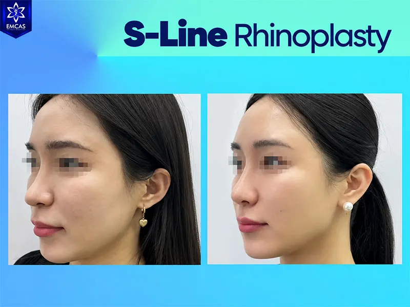 S-Line rhinoplasty cost varies according to surgical technique, materials, surgeon expertise and medical facility