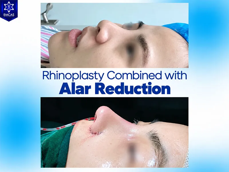 Swelling after alar base reduction commonly improves within 7 to 10 days, with the nasal base continuing to settle over the following months