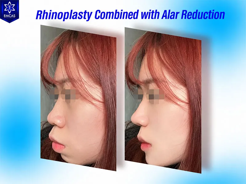 Alar base reduction may be considered for wide, thick, flared or asymmetrical nasal alae