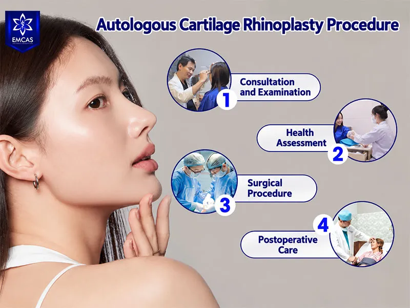 Autologous cartilage rhinoplasty at EMCAS includes consultation, health assessment, surgery, and postoperative monitoring