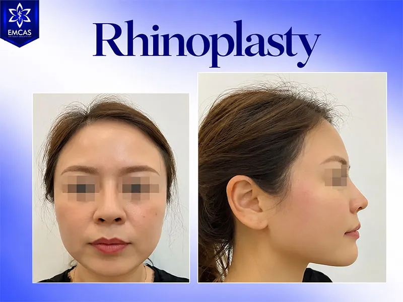 Rhinoplasty may reshape the bridge, tip or nasal base to create a more proportionate nasal contour