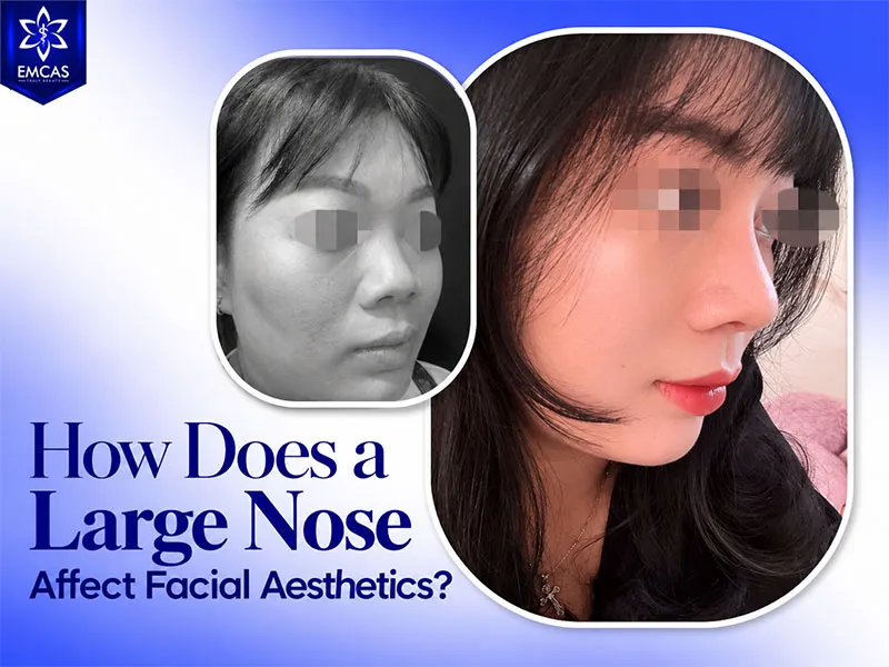 Wide nostrils can make the lower part of the nose appear broader and more prominent from the front
