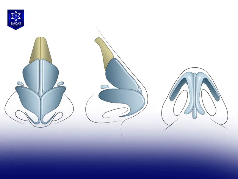 The nose continues to develop through childhood and adolescence as the facial bones, cartilage and soft tissues mature