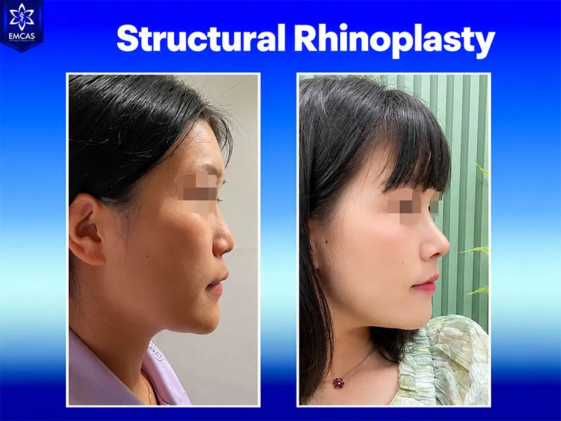 Swelling may begin to improve around 7 to 10 days after rhinoplasty