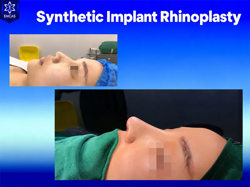 Rhinoplasty is performed under anesthesia to control pain during surgery