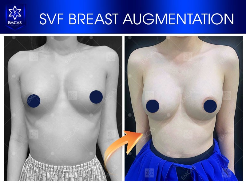 Aesthetic surgery patient case by Dr. Pham Xuan Khiem