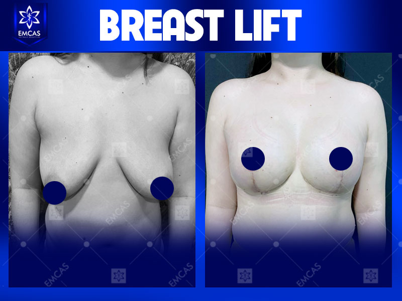Aesthetic treatment result by Dr. Pham Xuan Khiem at EMCAS