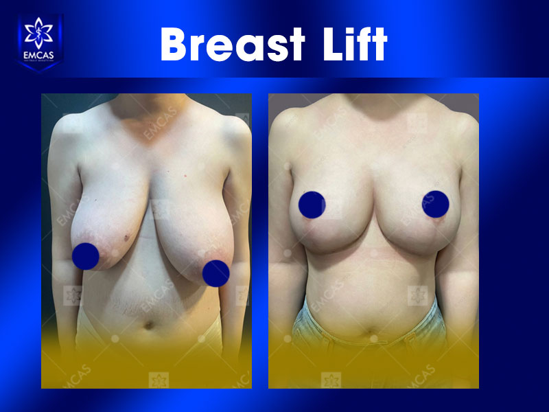 Patient result from Dr. Pham Xuan Khiem's aesthetic practice