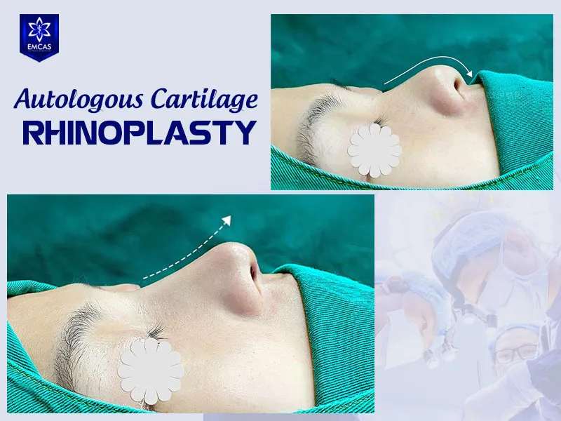 Key factors that affect ear cartilage rhinoplasty cost