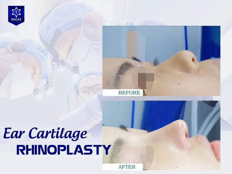 Ear cartilage rhinoplasty at EMCAS starts from VND 25 million
