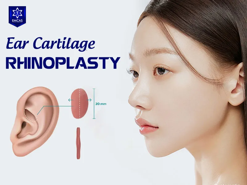 Ear cartilage rhinoplasty uses auricular cartilage to cover and support the nasal tip