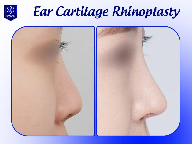 Ear cartilage and rib cartilage may be combined for long-lasting rhinoplasty results