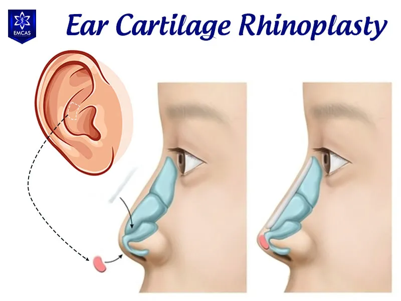 Ear cartilage harvested from the auricle for nasal tip coverage in rhinoplasty