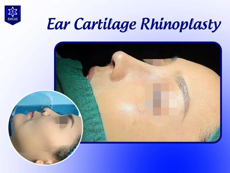Candidate considerations for ear cartilage rhinoplasty