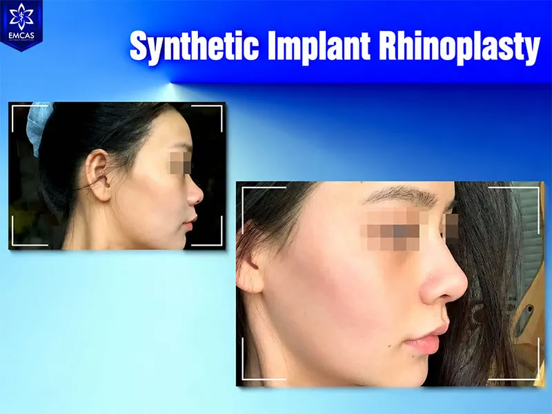 Rhinoplasty results may remain stable for many years depending on the technique and individual factors