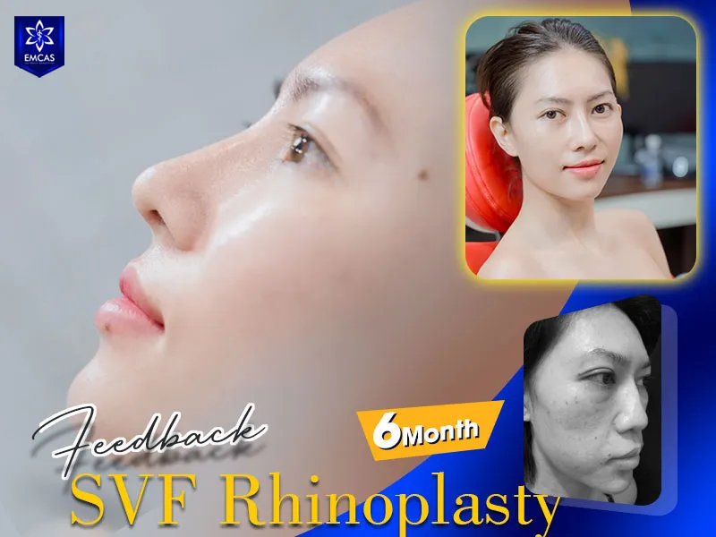 Rhinoplasty gradually settles as postoperative swelling decreases over the following months