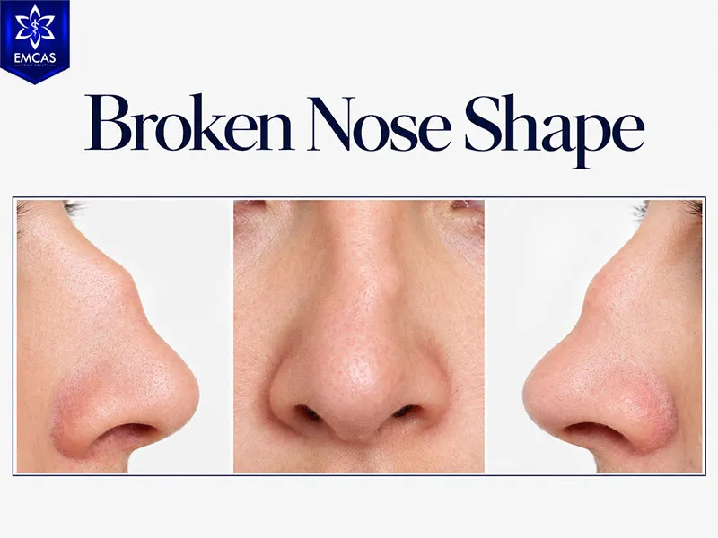 Male nose with an uneven or interrupted nose bridge
