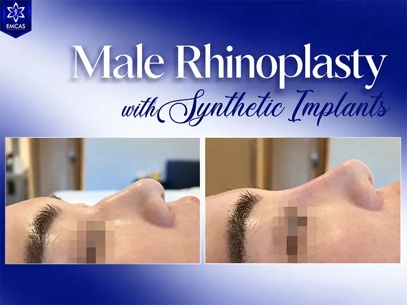 Male rhinoplasty designed to maintain facial balance and masculine features