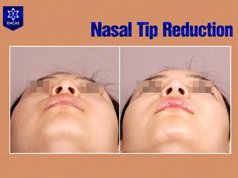 Nasal tip refinement can create a narrower and more balanced nasal tip
