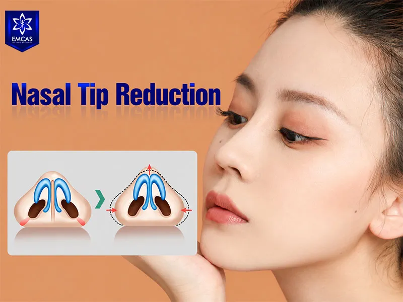 Nasal tip refinement surgery should be planned around individual nasal anatomy and safety