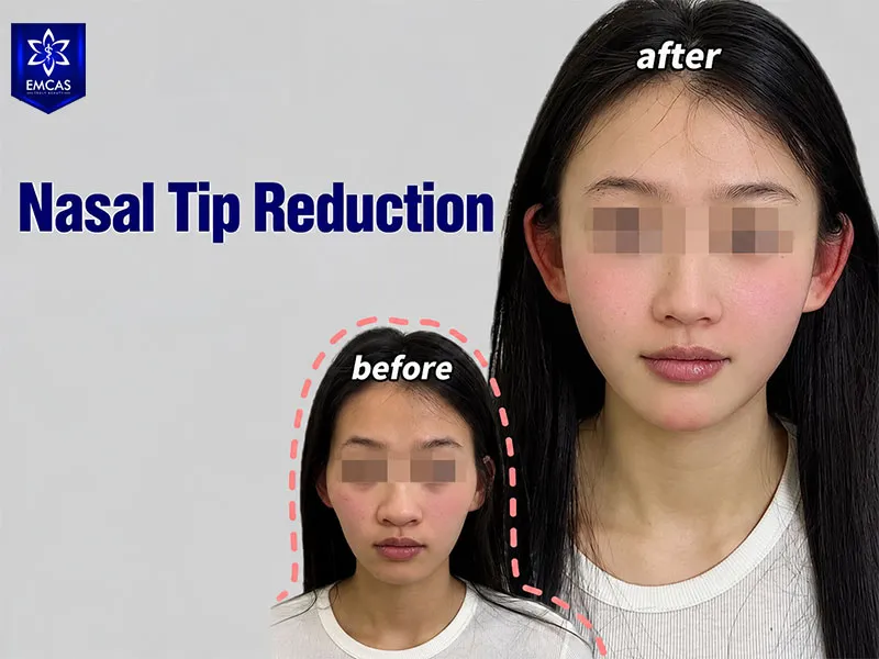 EMCAS Aesthetic Hospital provides consultation for nasal tip refinement surgery