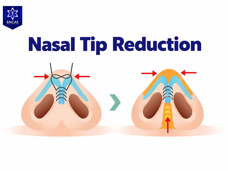 Nasal tip refinement can reduce the appearance of a broad or bulbous nasal tip