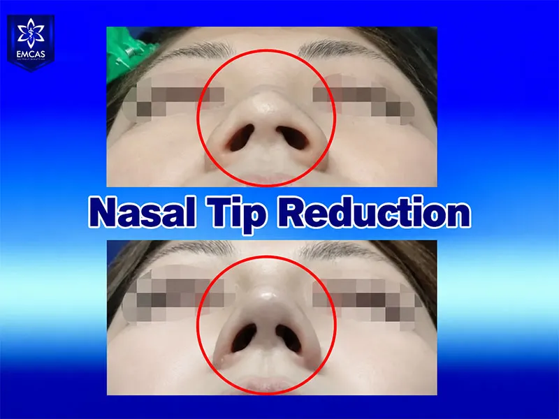 People with a broad or bulbous nasal tip may consider nasal tip refinement