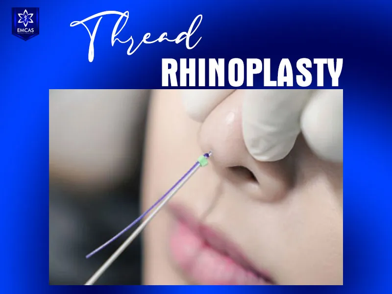 A nose thread lift uses biocompatible threads to support and elevate the nasal bridge