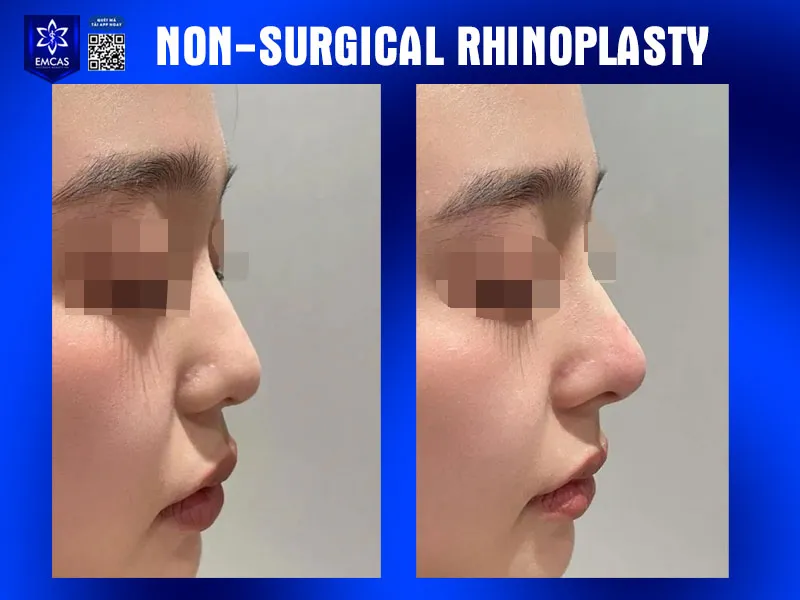 Nonsurgical rhinoplasty uses minimally invasive techniques to make subtle changes to the nose