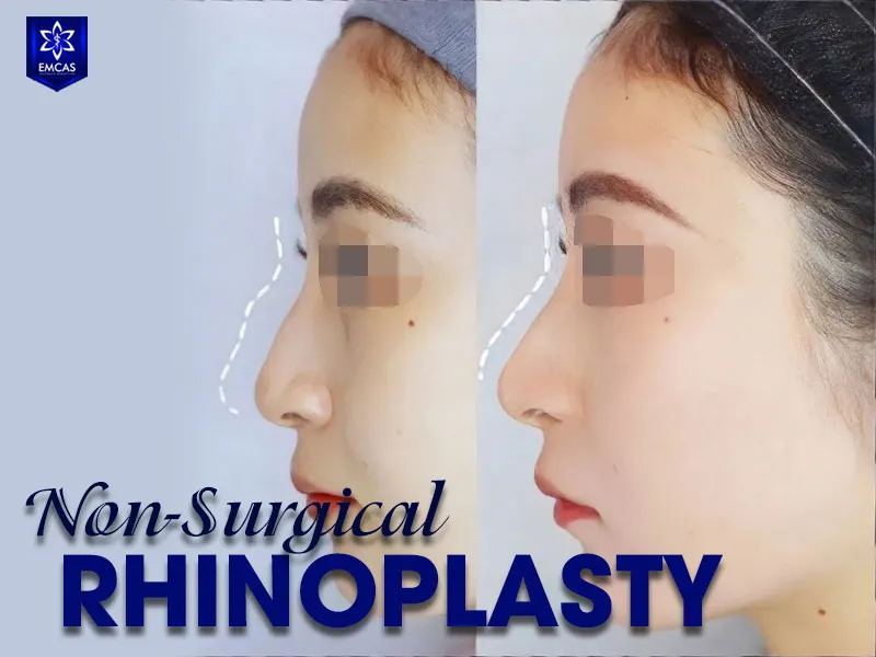 Nonsurgical rhinoplasty may be considered for people seeking subtle nasal contour changes without conventional surgery
