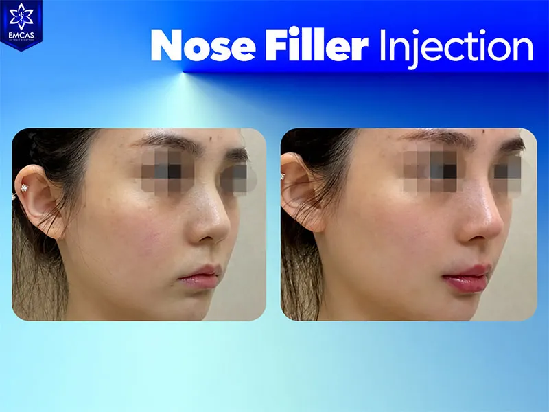 Nose filler results may last around 6 to 24 months depending on the filler, technique, and individual response