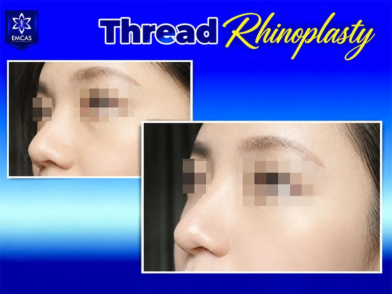 Aftercare following a nose thread lift can support recovery and the stability of the nasal contour