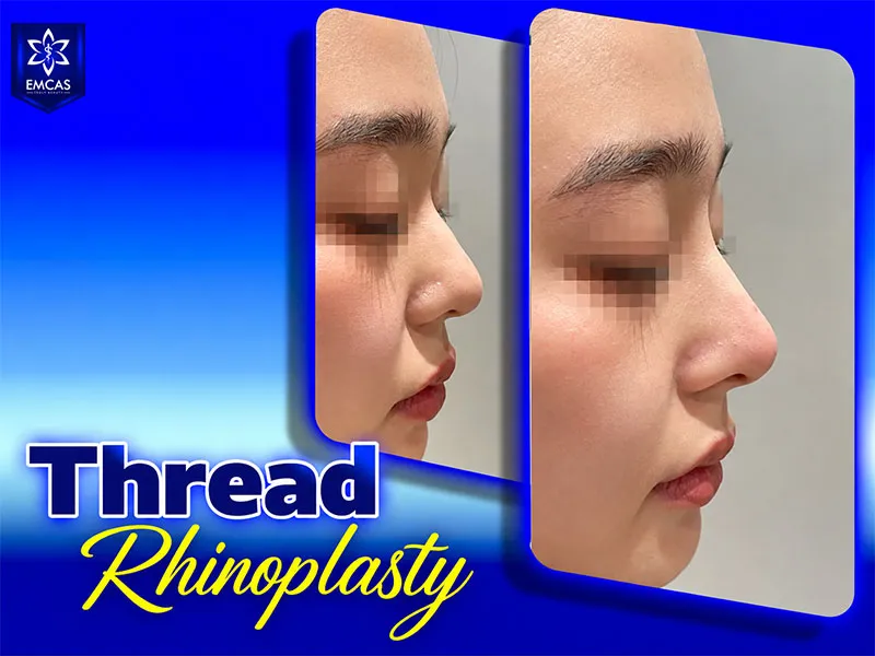 A nose thread lift may not be suitable when significant structural correction of the nose is needed