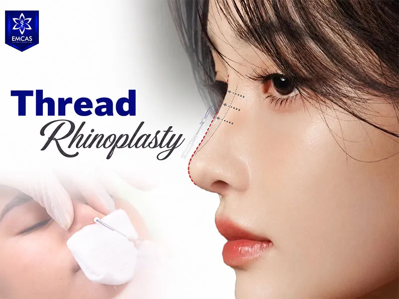 A nose thread lift is a minimally invasive procedure used to refine nasal shape and projection