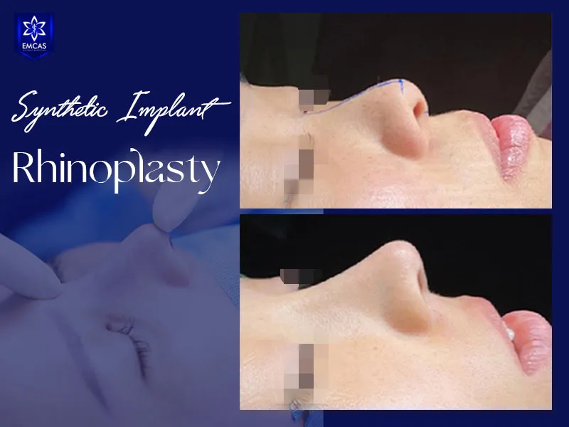 Factors that can affect rhinoplasty cost, including procedure type, surgeon experience, facility and nasal anatomy