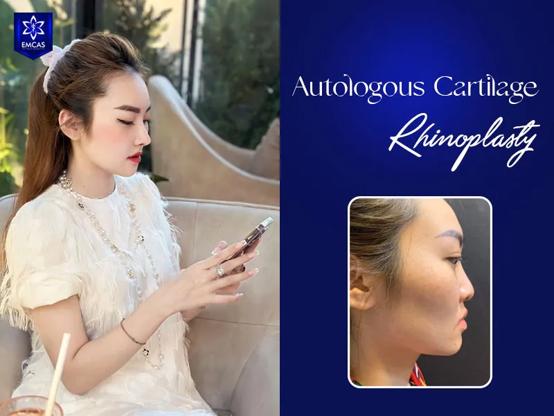 Autologous cartilage rhinoplasty at EMCAS starts from VND 25 million