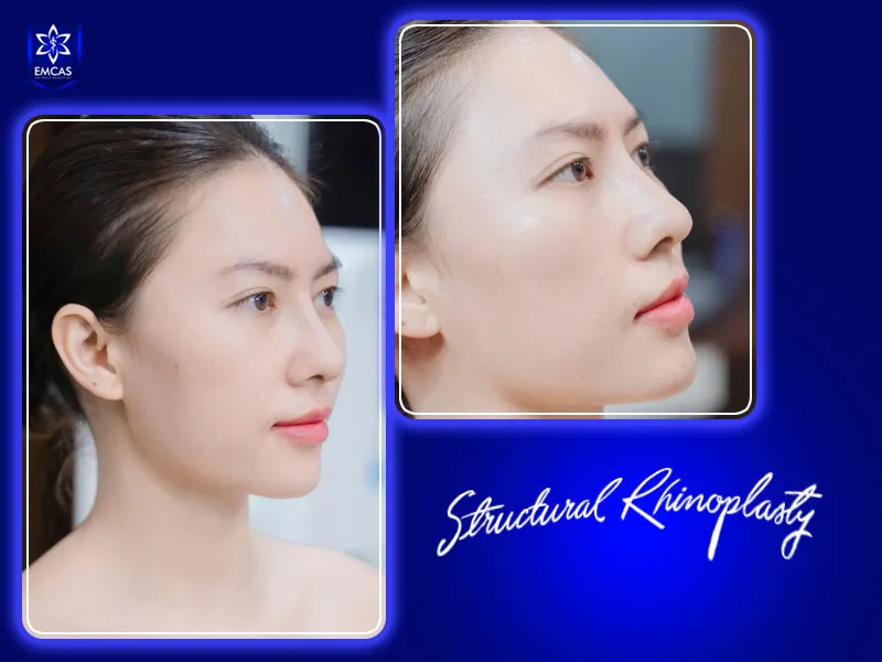 Structural rhinoplasty at EMCAS starts from VND 35 million