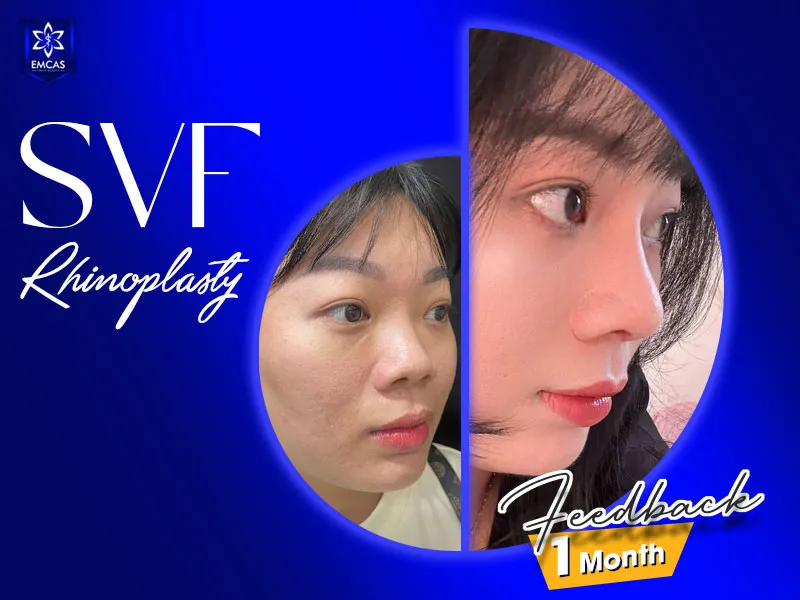 SVF rhinoplasty at EMCAS starts from VND 17 million