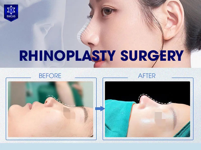 Preparation before rhinoplasty includes consultation, medical screening and following preoperative instructions