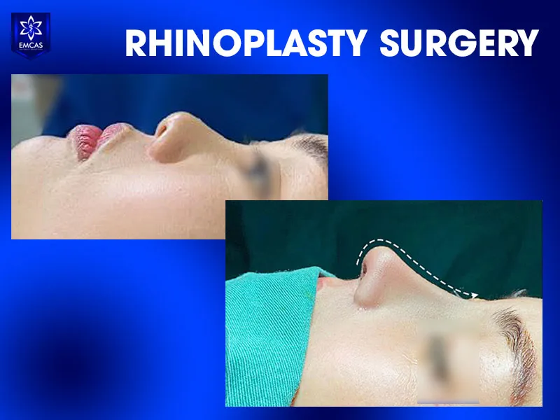 Post-rhinoplasty care is an important part of recovery and healing