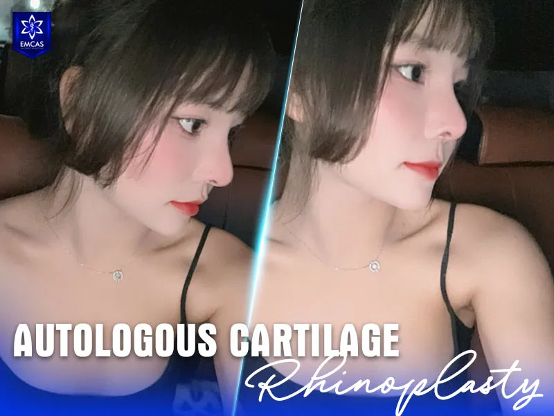 Rhinoplasty can reshape the bridge, tip and overall contour of the nose