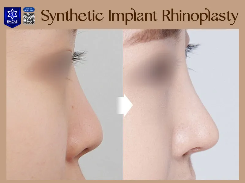 Common synthetic nasal implants include silicone and ePTFE-based materials used for augmentation rhinoplasty
