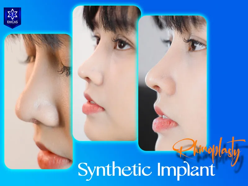 Rhinoplasty with a synthetic implant used to increase nasal bridge projection and refine nasal contour