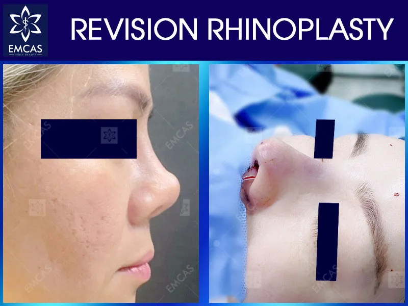 Revision rhinoplasty corrects or improves a previously operated nose when problems or unsatisfactory results remain