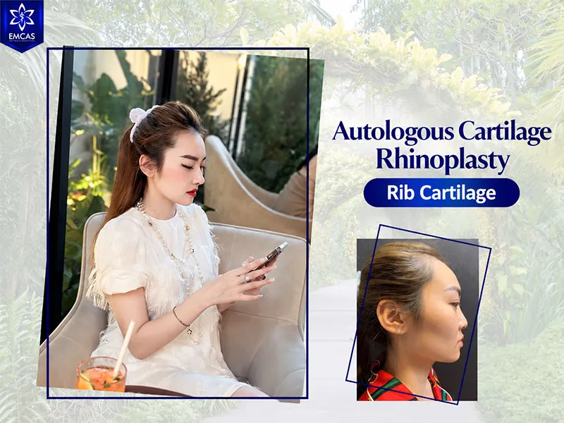 Rib cartilage grafts are designed to provide structural support, although resorption and other graft changes can occur