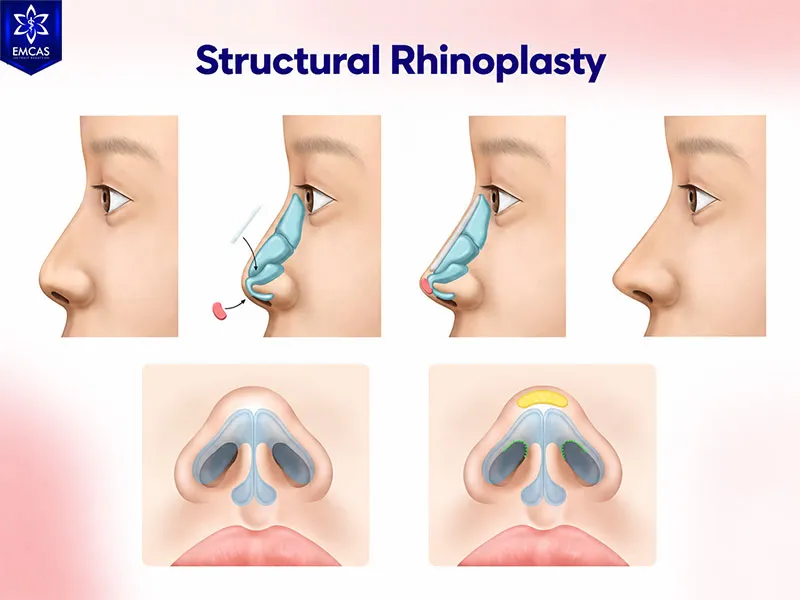 Structural rhinoplasty reshapes the bridge, tip and supporting nasal framework
