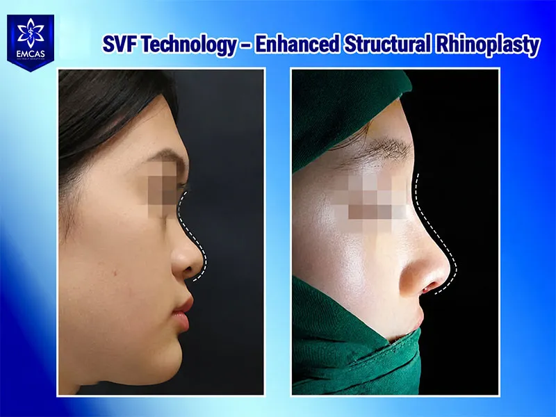 Structural rhinoplasty may be considered for primary rhinoplasty and revision cases